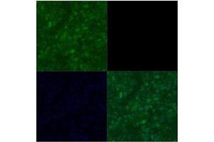 Primary Metastatic Melenoma Speciman Primary antibody dilution: 1:1000 (POU3F2 antibody  (Middle Region))