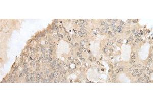 Immunohistochemistry of paraffin-embedded Human colorectal cancer tissue using ZZZ3 Polyclonal Antibody at dilution of 1:50(x200) (ZZZ3 antibody)