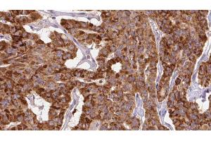 ABIN6267142 at 1/100 staining Human thyroid cancer tissue by IHC-P. (PPP1R12A antibody  (pThr696))