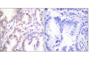 Immunohistochemistry analysis of paraffin-embedded human lung carcinoma tissue using CDK7 antibody. (CDK7 antibody  (C-Term))