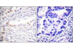 Immunohistochemistry analysis of paraffin-embedded human lung carcinoma tissue, using Uba2 Antibody. (UBA2 antibody  (AA 591-640))