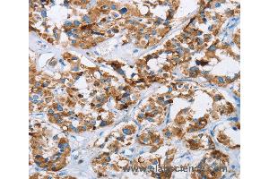 Immunohistochemistry of Human cervical cancer using HINT2 Polyclonal Antibody at dilution of 1:40 (HINT2 antibody)