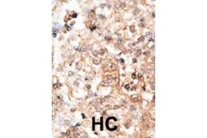Formalin-fixed and paraffin-embedded human cancer tissue reacted with the primary antibody, which was peroxidase-conjugated to the secondary antibody, followed by DAB staining. (Osteocalcin antibody  (N-Term))