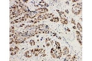 IHC-P: MCM2 antibody testing of human lung cancer tissue