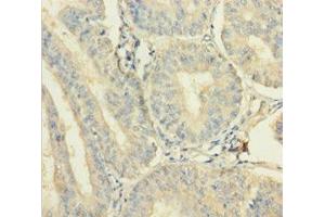 Immunohistochemistry of paraffin-embedded human endometrial cancer using ABIN7175017 at dilution of 1:100 (C12orf49 antibody  (AA 34-205))