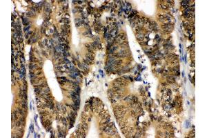 IHC(P): Human Intestinal Cancer Tissue (MAPK13 antibody  (C-Term))