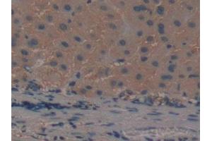 DAB staining on IHC-P; Samples: Human Liver cancer Tissue (ADAMTS5 antibody  (AA 485-622))