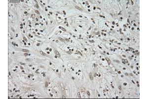 Immunohistochemical staining of paraffin-embedded Carcinoma of kidney tissue using anti-BUB1Bmouse monoclonal antibody. (BUB1B antibody)