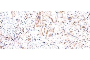 Immunohistochemistry of paraffin-embedded Human cervical cancer tissue using PHKG2 Polyclonal Antibody at dilution of 1:60(x200) (PHKG2 antibody)