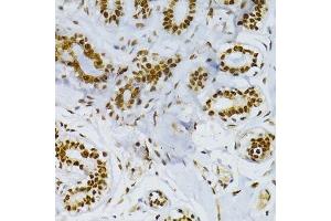 Immunohistochemistry of paraffin-embedded human breast cancer using SNRNP70 antibody. (SNRNP70 antibody  (AA 150-250))