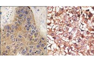(LEFT)Formalin-fixed and paraffin-embedded human hepatocarcinoma tissue reacted with CHIP (STUB1) antibody (C-term), which was peroxidase-conjugated to the secondary antibody, followed by DAB staining. (STUB1 antibody  (C-Term))