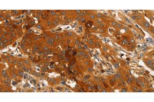Immunohistochemistry of paraffin-embedded Human lung cancer using ORM2 Polyclonal Antibody at dilution of 1:40 (Orosomucoid 2 antibody)