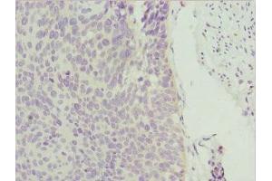 Immunohistochemistry of paraffin-embedded human cervical cancer using ABIN7176006 at dilution of 1:100 (ZNF187 antibody  (AA 239-478))