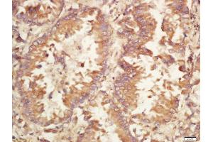 Formalin-fixed and paraffin embedded human lung carcinoma labeled with Rabbit Anti-Caspase-9 (Ser196) Polyclonal Antibody, Unconjugated (ABIN756922) at 1:200 followed by conjugation to the secondary antibody and DAB staining (Caspase 9 antibody  (pSer196))