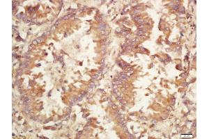 Formalin-fixed and paraffin embedded human lung carcinoma labeled with Rabbit Anti-Caspase-9 (Ser196) Polyclonal Antibody, Unconjugated (ABIN756922) at 1:200 followed by conjugation to the secondary antibody and DAB staining (Caspase 9 antibody  (pSer196))