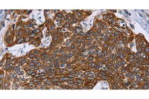 Immunohistochemistry of paraffin-embedded Human cervical cancer using GRPR Polyclonal Antibody at dilution of 1:40 (GRPR antibody)