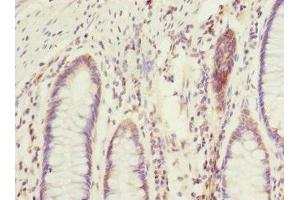 Immunohistochemistry of paraffin-embedded human colon cancer using ABIN7172903 at dilution of 1:100 (EIF2B2 antibody  (AA 1-351))