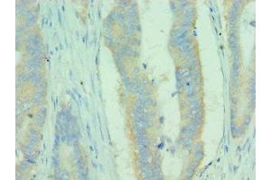 Immunohistochemistry of paraffin-embedded human colon cancer using ABIN7159681 at dilution of 1:100 (MICA antibody  (AA 24-307))
