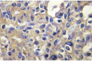 Immunohistochemistry (IHC) analyzes of MELK antibody in paraffin-embedded human liver carcinoma tissue. (MELK antibody)