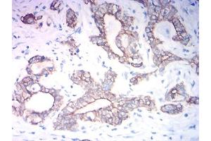 Immunohistochemical analysis of paraffin-embedded stomach cancer tissues using KRT19 mouse mAb with DAB staining. (Cytokeratin 19 antibody  (AA 80-400))