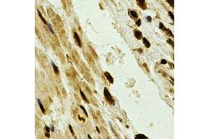 Immunohistochemical analysis of PSMA2 staining in human esophageal cancer formalin fixed paraffin embedded tissue section. (PSMA2 antibody)