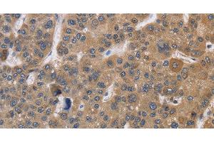Immunohistochemistry of paraffin-embedded Human liver cancer using SDCCAG3 Polyclonal Antibody at dilution of 1:30 (SDCCAG3 antibody)