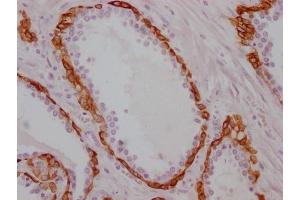 IHC image of ABIN7180960 diluted at 1:100 and staining in paraffin-embedded human prostate cancer performed on a Leica BondTM system. (KRT17 antibody)