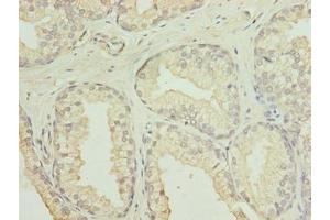 Immunohistochemistry of paraffin-embedded human prostate cancer using ABIN7153936 at dilution of 1:100 (GID8/C20orf11 antibody  (AA 1-228))