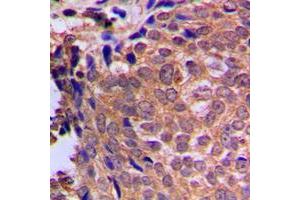 Immunohistochemical analysis of Cofilin staining in human breast cancer formalin fixed paraffin embedded tissue section. (Cofilin antibody  (N-Term))