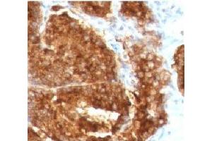 IHC staining of human prostate carcinoma with TAG-72 antibody