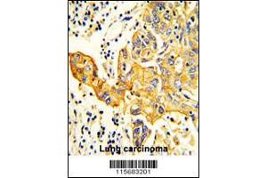 Formalin-fixed and paraffin-embedded human Lung carcinoma reacted with RARS2 Antibody , which was peroxidase-conjugated to the secondary antibody, followed by DAB staining. (RARS2 antibody  (C-Term))