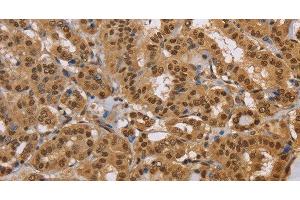 Immunohistochemistry of paraffin-embedded Human thyroid cancer using CEL Polyclonal Antibody at dilution of 1:40 (Cholesterol Esterase antibody)