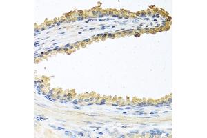 Immunohistochemistry of paraffin-embedded human prostate using COCH antibody (ABIN6132126, ABIN6138819, ABIN6138820 and ABIN6222234) at dilution of 1:100 (40x lens).