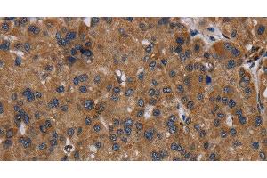 Immunohistochemistry of paraffin-embedded Human liver cancer using NDUFS8 Polyclonal Antibody at dilution of 1:50 (NDUFS8 antibody)