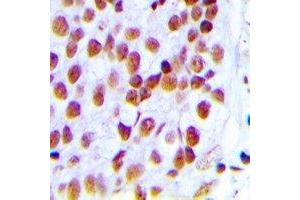 Immunohistochemical analysis of Ku80 staining in human breast cancer formalin fixed paraffin embedded tissue section. (XRCC5 antibody  (C-Term))
