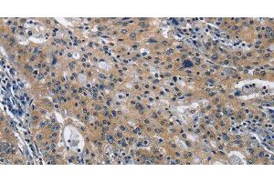 Immunohistochemistry of paraffin-embedded Human gastric cancer using CD160 Polyclonal Antibody at dilution of 1:30 (CD160 antibody)