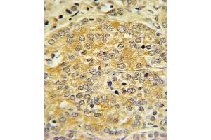 OL1 Antibody (C-term) 7361b IHC analysis in formalin fixed and paraffin embedded human Prostate carcinoma followed by peroxidase conjugation of the secondary antibody and DAB staining. (APOL1 antibody  (C-Term))