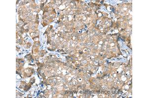 Immunohistochemistry of Human breast cancer using SESN2 Polyclonal Antibody at dilution of 1:30 (Sestrin 2 antibody)