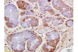 Formalin-fixed and paraffin embedded human lung carcinoma labeled with Rabbit Anti CKMT/Creatine kinase MT Polyclonal Antibody, Unconjugated (ABIN717536) at 1:200 followed by conjugation to the secondary antibody and DAB staining (CKMT1B antibody  (AA 115-220))