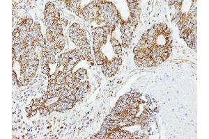 IHC-P Image Immunohistochemical analysis of paraffin-embedded OVCA xenograft, using DCI, antibody at 1:100 dilution. (DCI antibody)