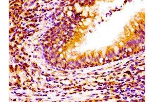 Immunohistochemistry of paraffin-embedded human lung cancer using ABIN7161195 at dilution of 1:100 (NCAM2 antibody  (AA 209-333))