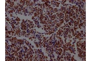 IHC image of ABIN7127590 diluted at 1:100 and staining in paraffin-embedded human lung cancer performed on a Leica BondTM system. (Recombinant LSD1 antibody)