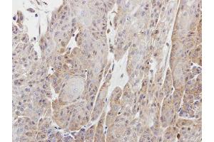 IHC-P Image Immunohistochemical analysis of paraffin-embedded Cal27 xenograft, using Copine I, antibody at 1:100 dilution. (CPNE1 antibody)