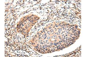 The image on the left is immunohistochemistry of paraffin-embedded Human esophagus cancer tissue using ABIN7191260(Lambda Light chain Antibody) at dilution 1/20, on the right is treated with synthetic peptide. (IGLV1-51 antibody)