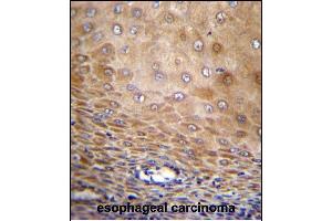 TMEM43 Antibody (Center) (ABIN656549 and ABIN2845811) immunohistochemistry analysis in formalin fixed and paraffin embedded human esophageal carcinoma followed by peroxidase conjugation of the secondary antibody and DAB staining. (TMEM43 antibody  (AA 195-223))