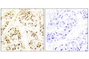 Immunohistochemistry analysis of paraffin-embedded human breast carcinoma tissue using FEN1 antibody. (FEN1 antibody  (Internal Region))