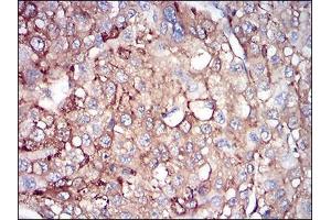 Immunohistochemical analysis of paraffin-embedded liver cancer tissues using FTL mouse mAb with DAB staining. (FTL antibody  (AA 1-157))