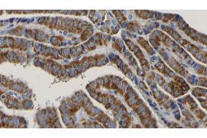 ABIN6267171 at 1/100 staining Human thyroid cancer tissue by IHC-P. (RIPK1 antibody  (pSer166))