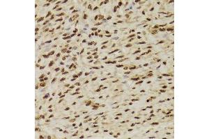 Immunohistochemistry of paraffin-embedded human adenomyosis using ANP32A Antibody. (PHAP1 antibody  (AA 1-170))