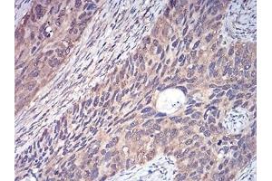 Immunohistochemical analysis of paraffin-embedded human cervical cancer tissues using YWHAB mouse mAb with DAB staining. (YWHAB antibody  (AA 1-246))